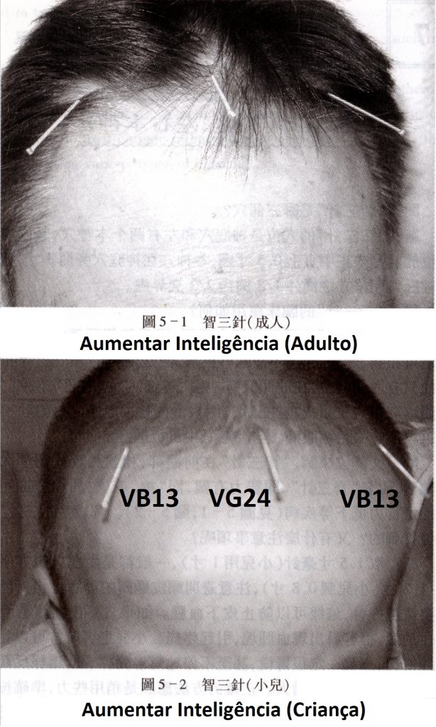 Foto de adulto e de criança com agulhas inseridas nos 3 Pontos para inteligência e raciocínio. 
Uma agulha na linha mediana, no Ponto VG24; e duas agulhas nos Pontos VB13 direito e esquerdo. 