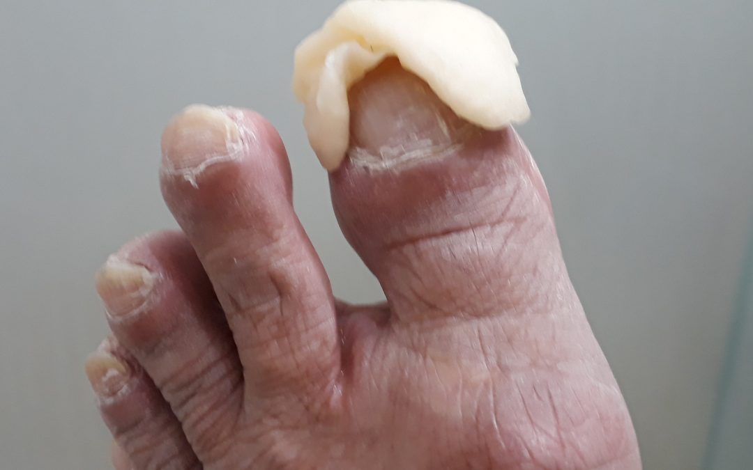 Xxiii…xiii, Como tratar Micose das Unhas?