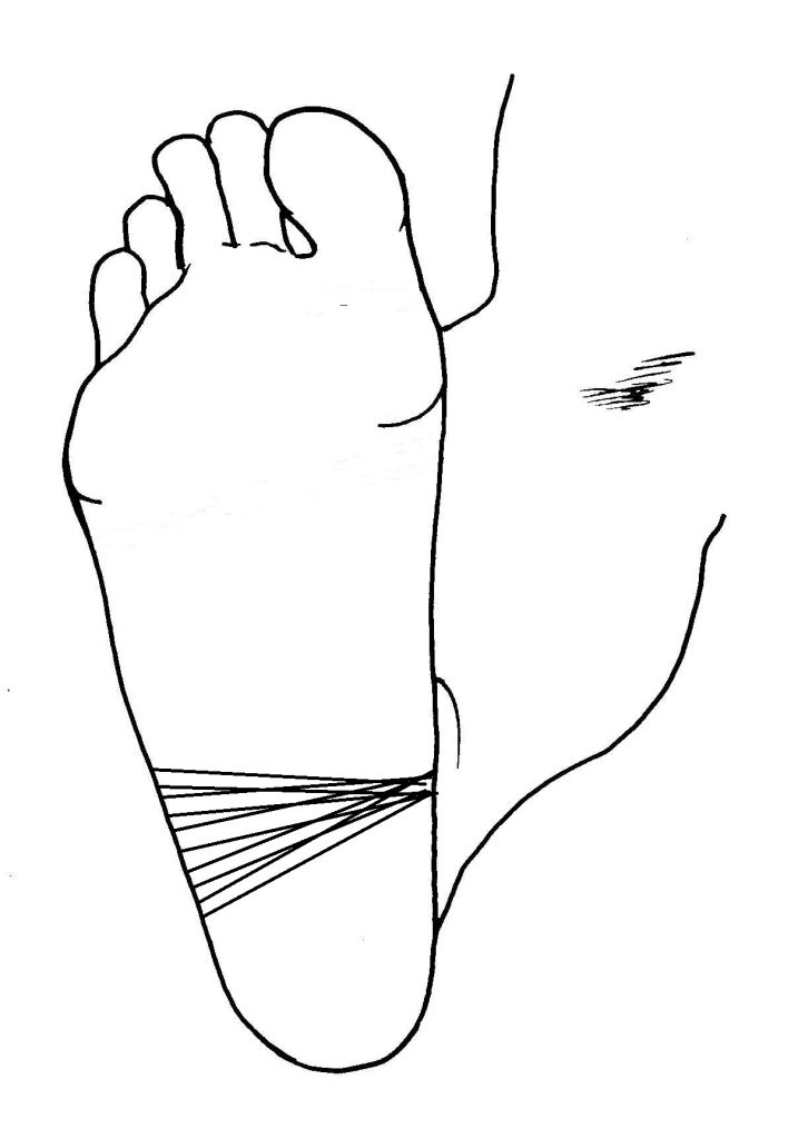 Fitas de esparadrapo terminando num ponto da borda medial do pé